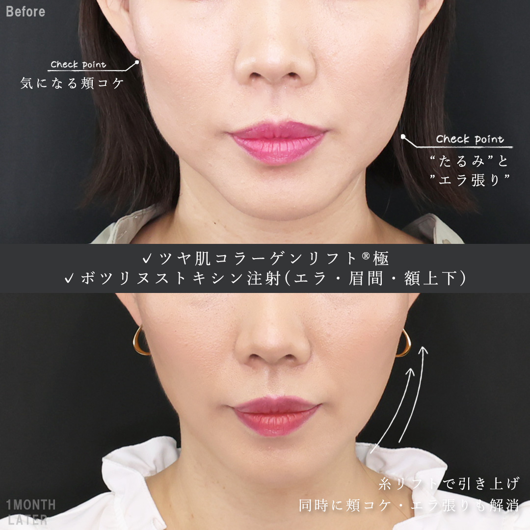 TAC式 ツヤ肌コラーゲンリフト®/エラボトックス注射/眉間のしわ取りボトックス注射の症例写真 施術前後 