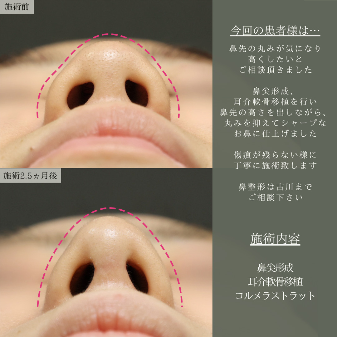 鼻尖形成・鼻尖縮小/鼻先軟骨移植の症例写真 施術前後 