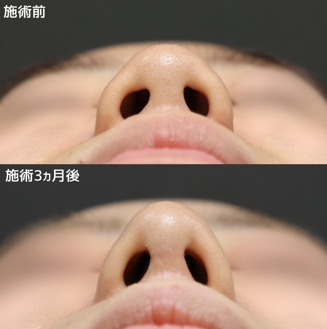 《鼻尖形成＋耳介軟骨移植》で憧れのシャープな鼻先へ