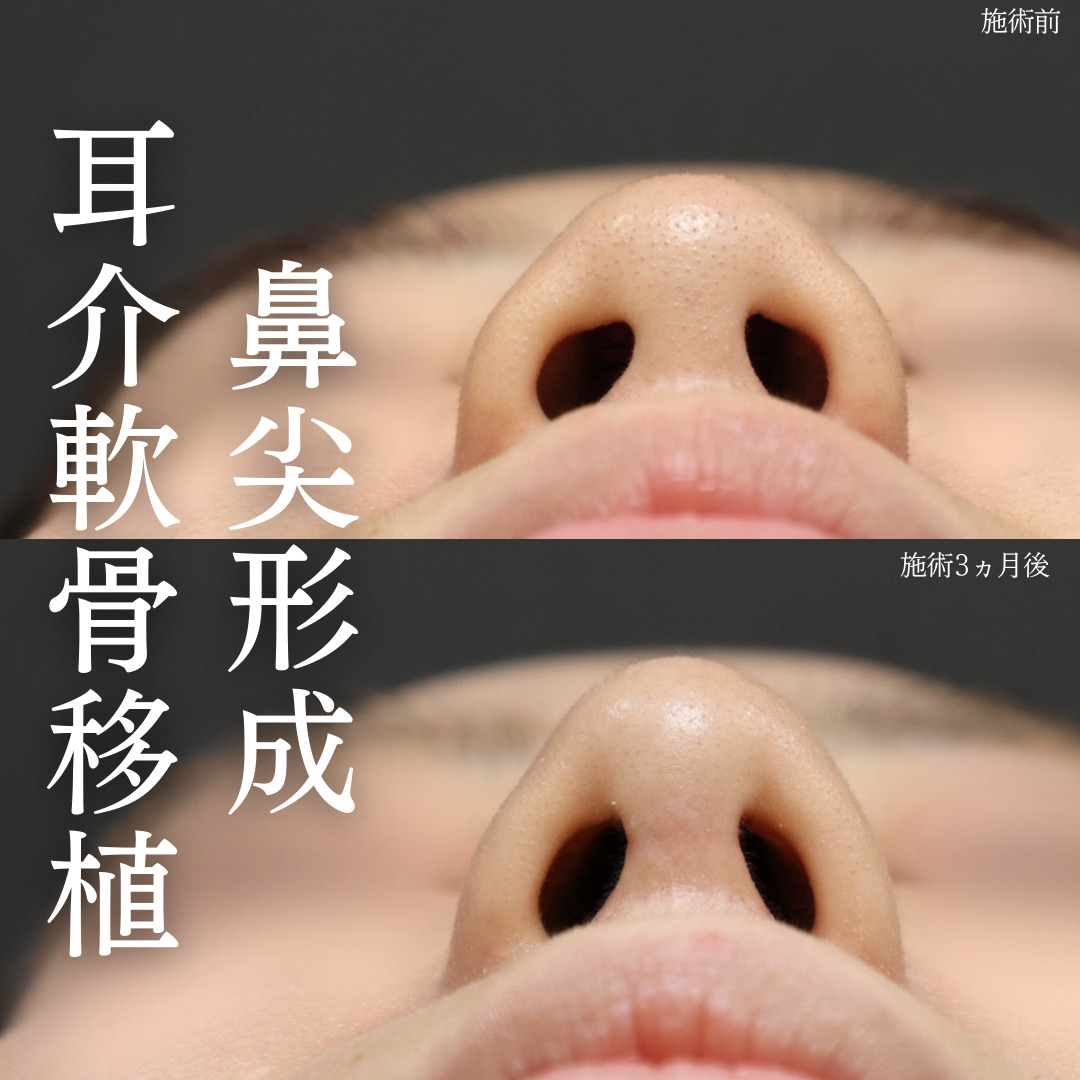 鼻尖形成・鼻尖縮小/鼻先軟骨移植の症例写真 施術前後 