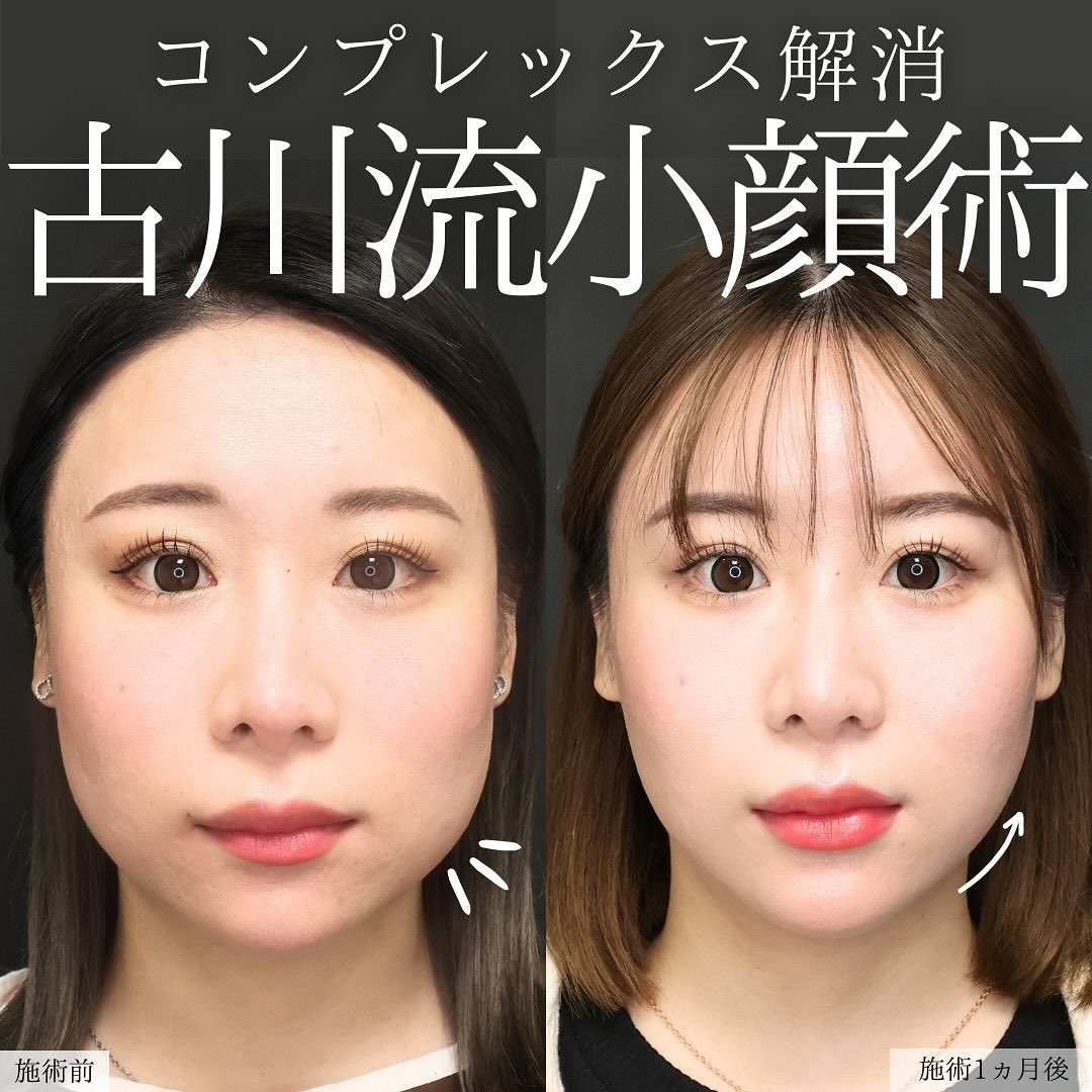 TAC式 ツヤ肌コラーゲンリフト®/Lラインファット除去（エラ下脂肪除去）/顔の脂肪吸引の症例写真 施術前後 