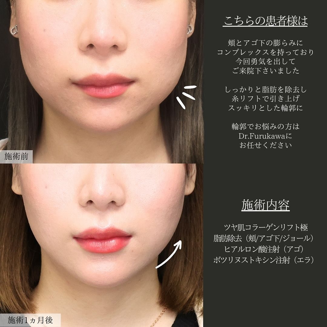 TAC式 ツヤ肌コラーゲンリフト®/Lラインファット除去（エラ下脂肪除去）/顔の脂肪吸引の症例写真 施術前後 