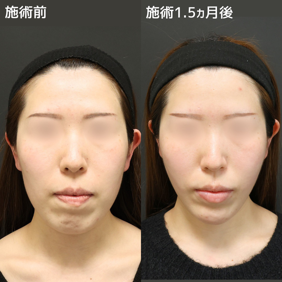 TAC式 ツヤ肌コラーゲンリフト®/ジョールファット除去/顔の脂肪吸引の症例写真 施術前後