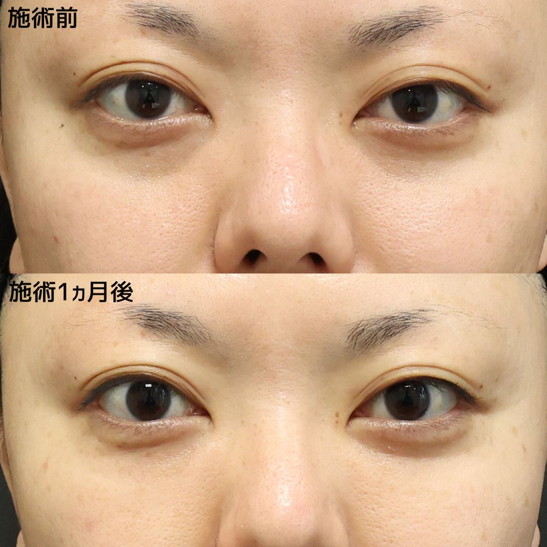 《クマ取り》疲れた印象から明るいお目元へ