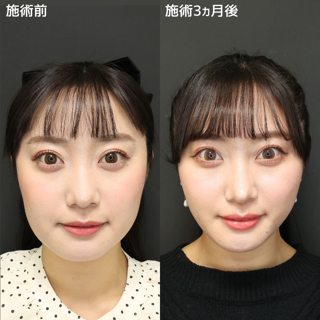 《小顔整形》人に見せたくなるモデル級の輪郭へ