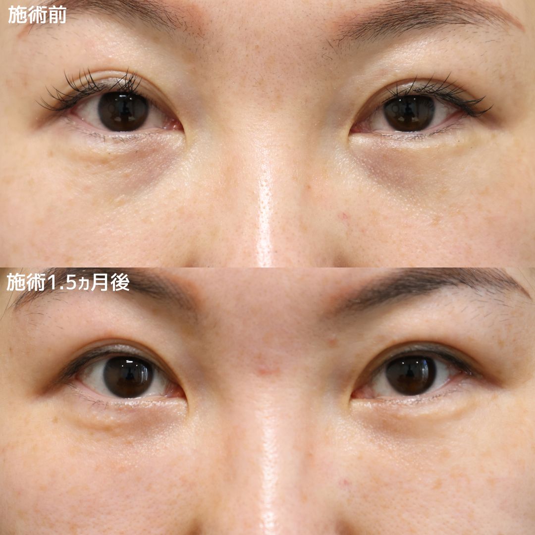 《クマ取り》毎朝のメイク時間も短縮