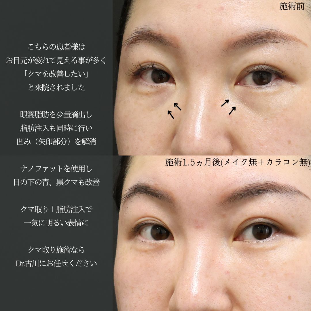 下眼瞼脱脂術（目の下のたるみ取り・目の下の脂肪ふくらみ取り）の症例写真 施術前後 