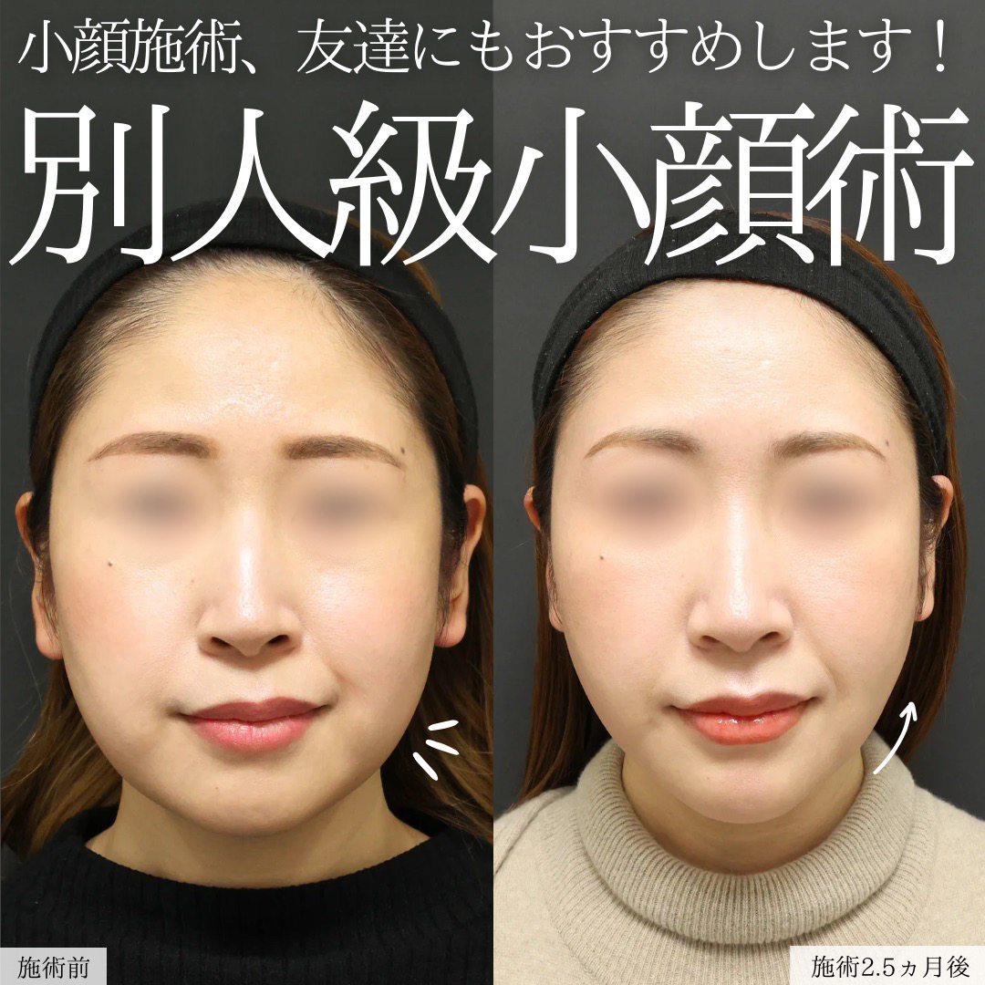 TAC式 ツヤ肌コラーゲンリフト®/ジョールファット除去/Lラインファット除去(エラ下脂肪除去)の症例写真 施術前後