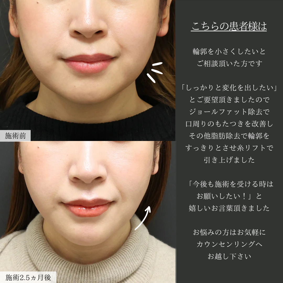 TAC式 ツヤ肌コラーゲンリフト®/ジョールファット除去/Lラインファット除去(エラ下脂肪除去)の症例写真 施術前後