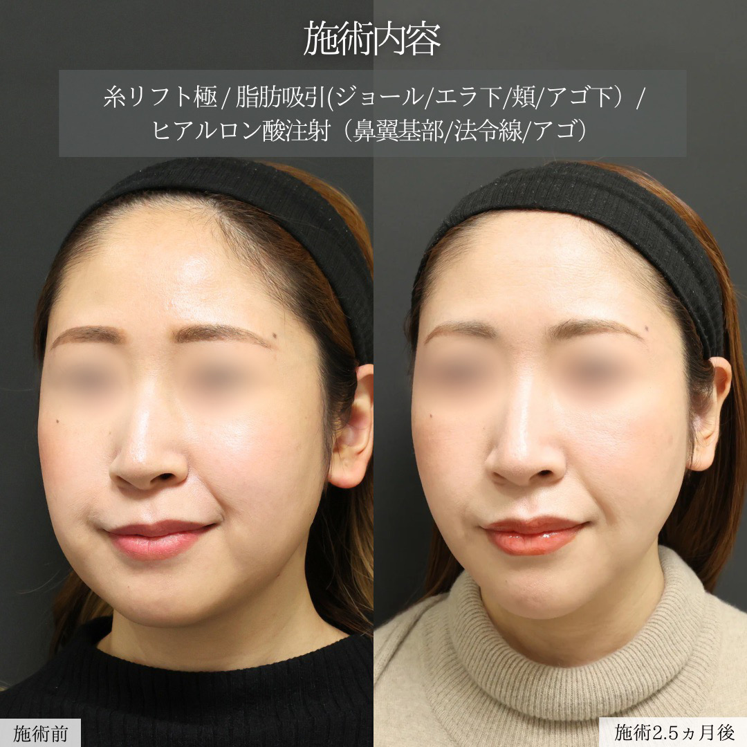 TAC式 ツヤ肌コラーゲンリフト®/ジョールファット除去/Lラインファット除去(エラ下脂肪除去)の症例写真 施術前後