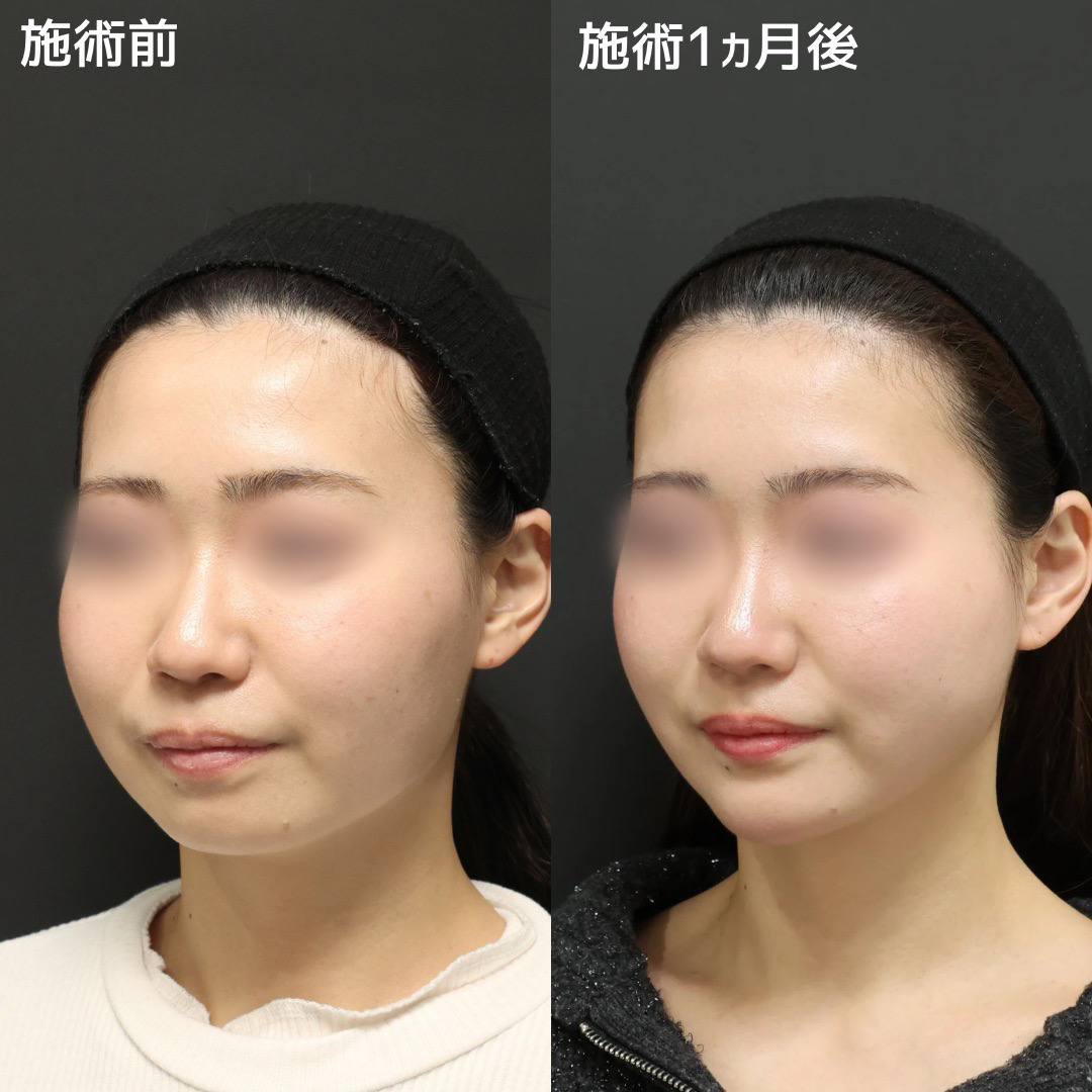 《小顔整形》糸リフト×脂肪除去でもたつきからの卒業