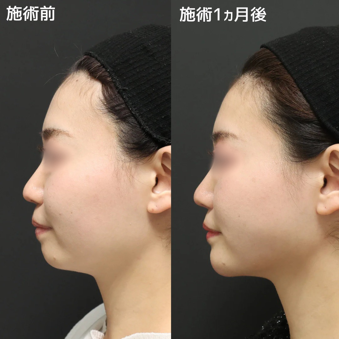TAC式 ツヤ肌コラーゲンリフト®/顎下の脂肪吸引/ジョールファット除去の症例写真 施術前後 