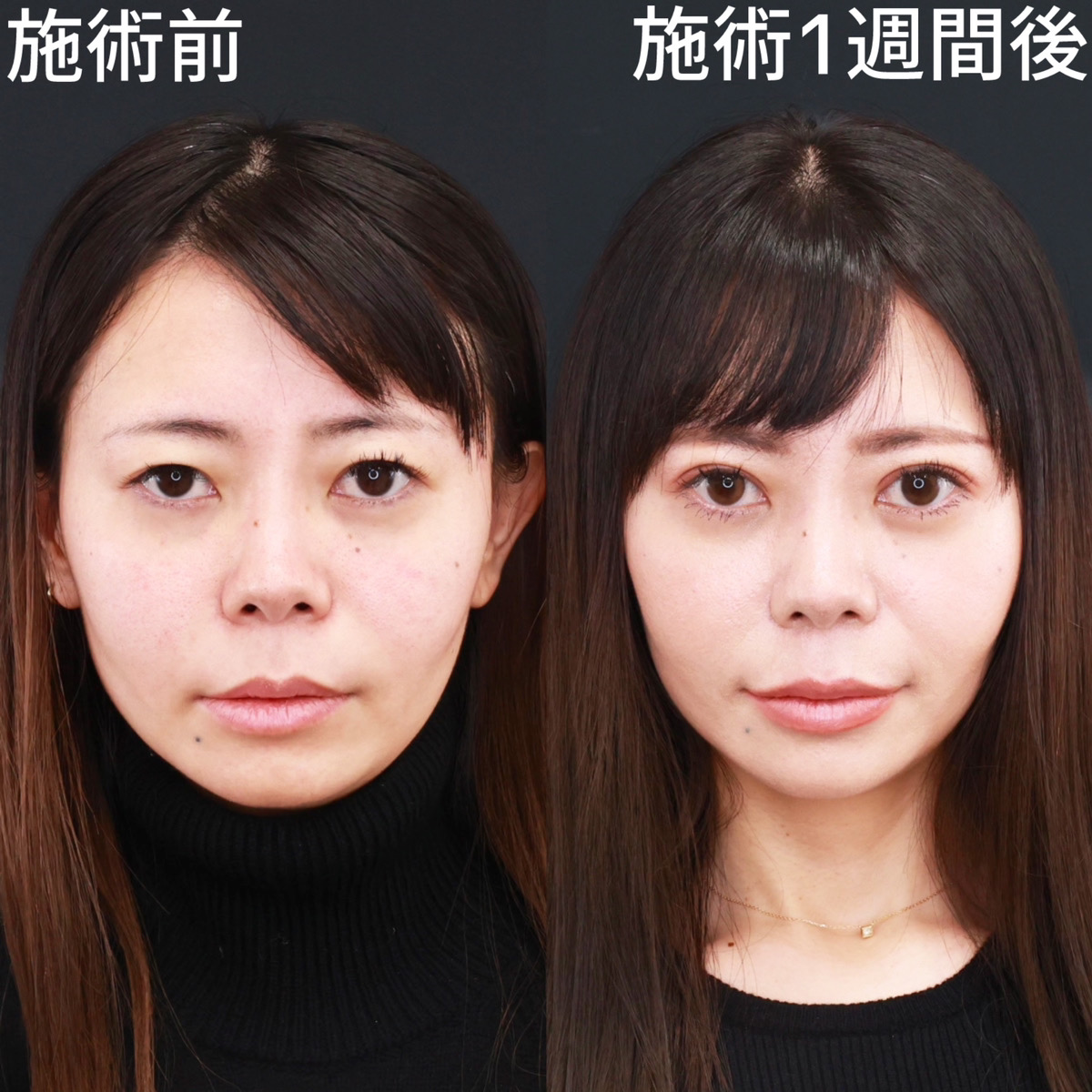 【クイックコスメリング】二重幅を取り戻す！パッチリ平行二重で若返り！