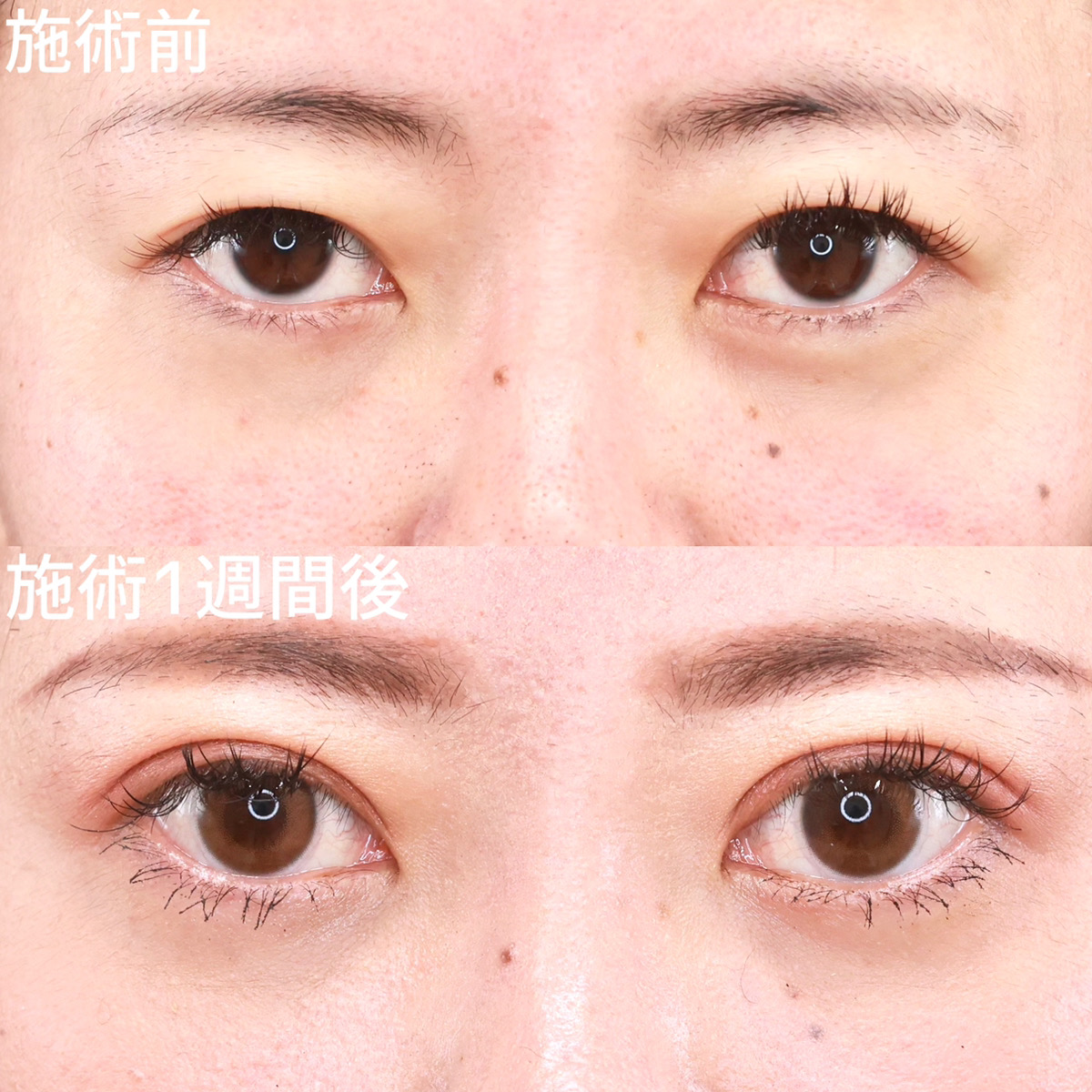 クイックコスメリング/ヒアルロン酸注射：その他/エラボトックス注射の症例写真 施術前後 