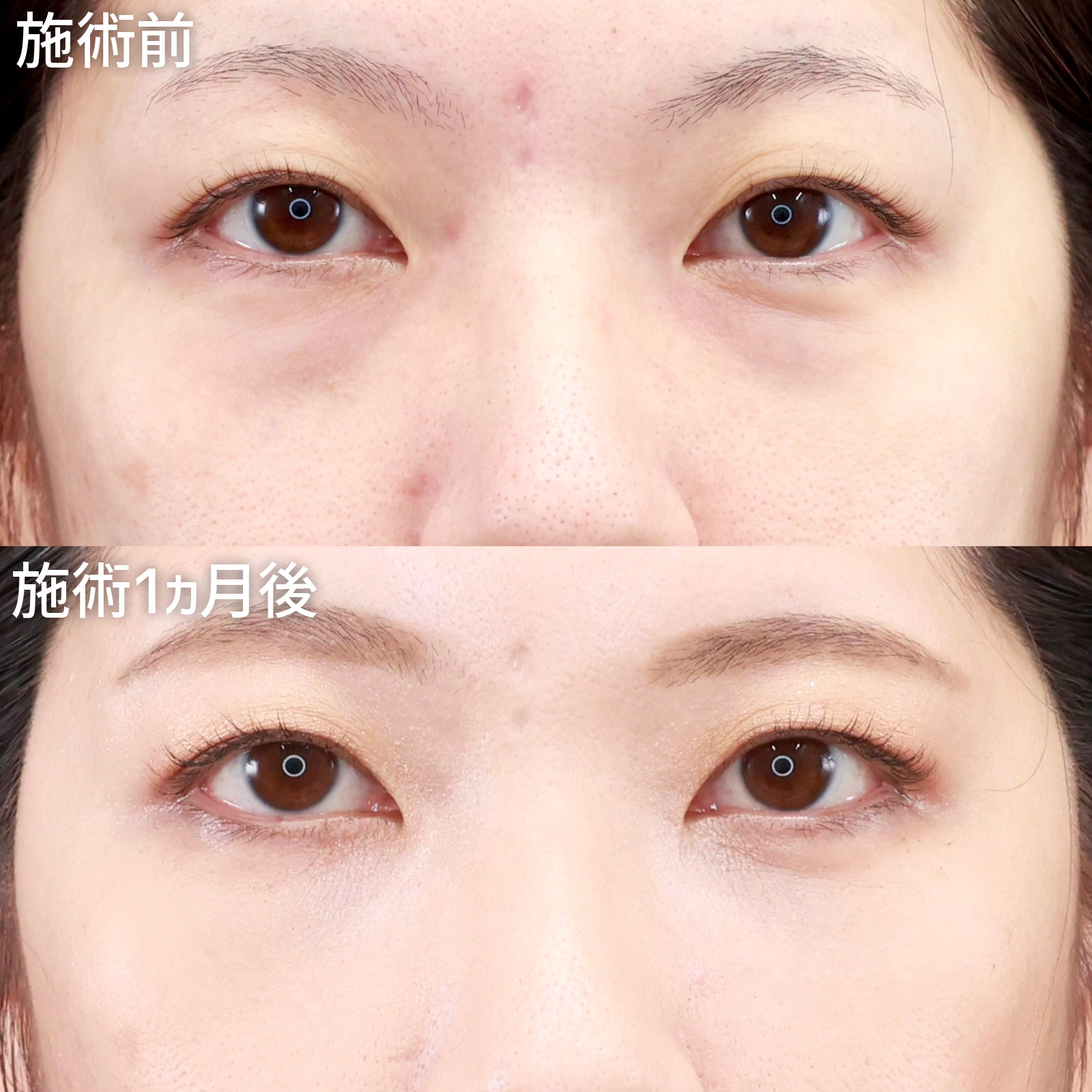 【下眼瞼脱脂術】疲れてる？なんてもう言わせない！目の下のクマ取りで明るい目元に大変身！