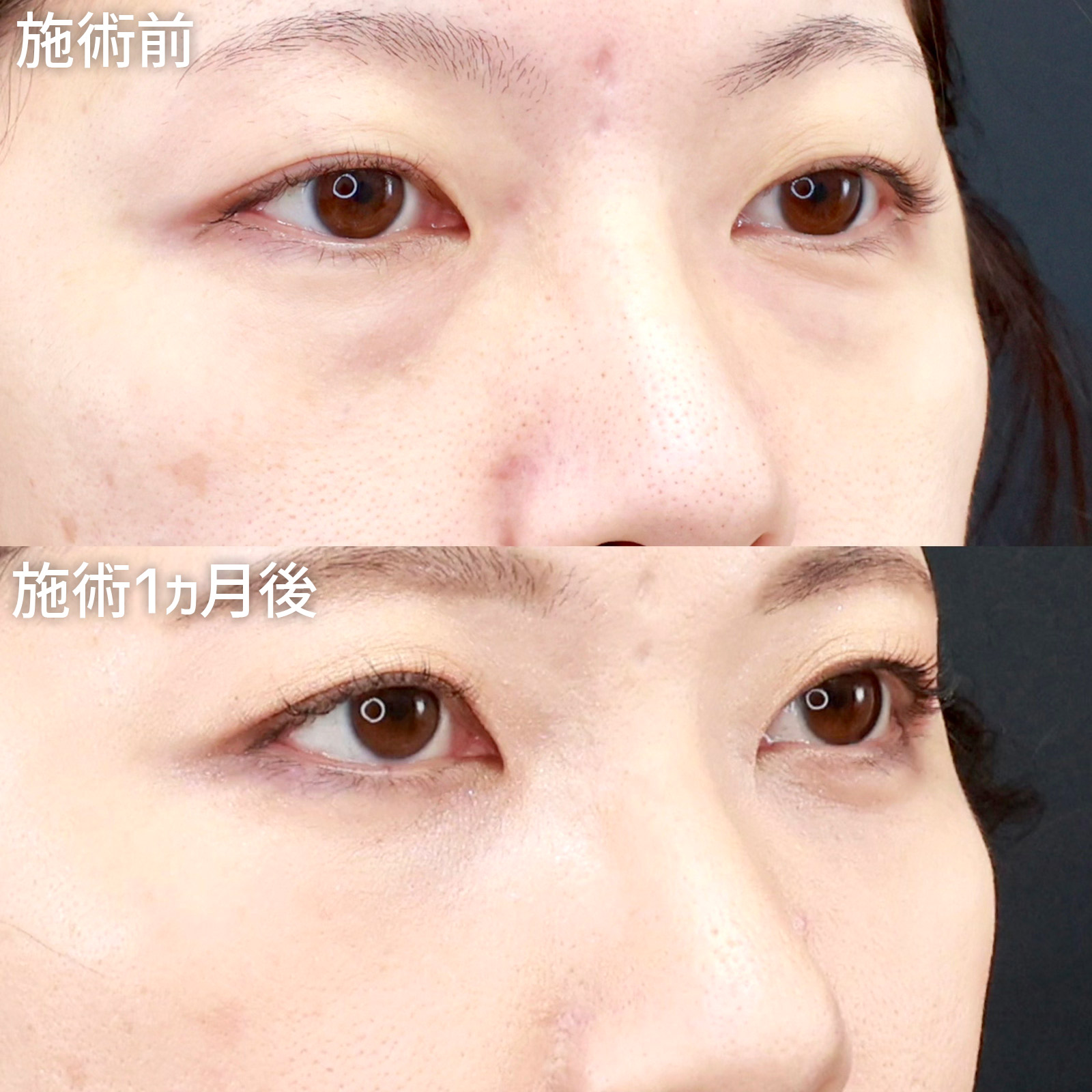 下眼瞼脱脂術（目の下のたるみ取り・目の下の脂肪ふくらみ取り）/顔の脂肪注入(コンデンスリッチフェイス)の症例写真 施術前後 