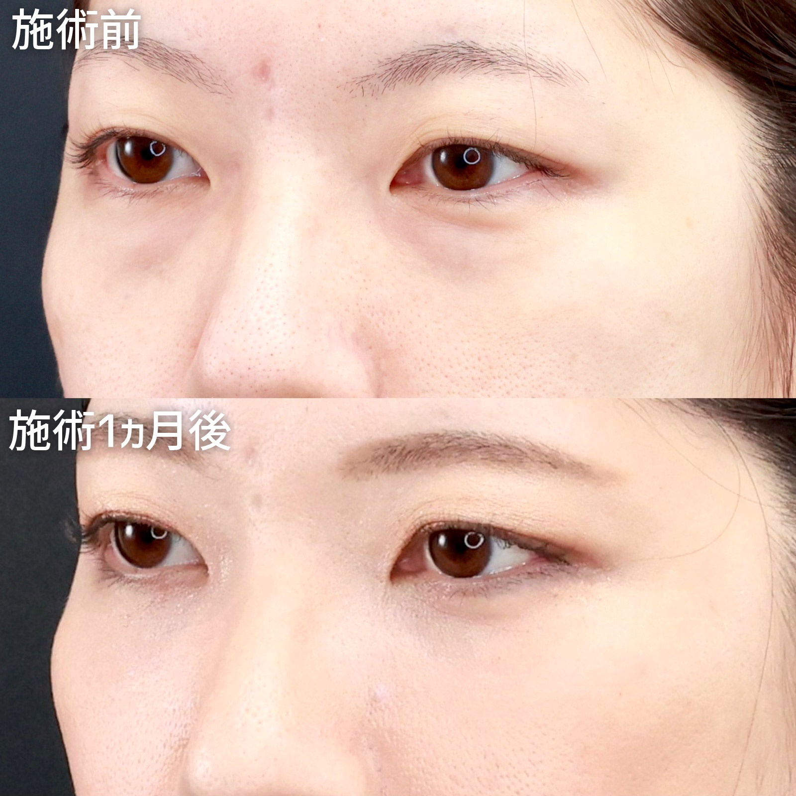 下眼瞼脱脂術（目の下のたるみ取り・目の下の脂肪ふくらみ取り）/顔の脂肪注入(コンデンスリッチフェイス)の症例写真 施術前後 