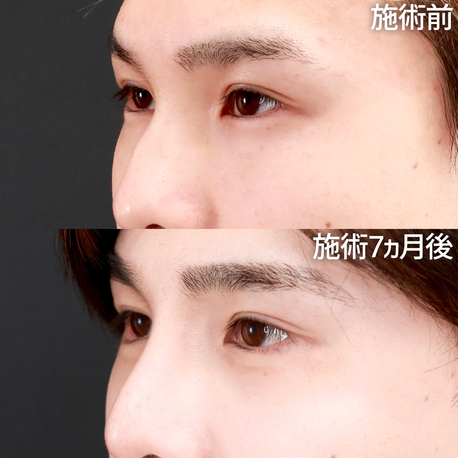 グラマラスライン（タレ目形成）/隆鼻術（プロテーゼ・自家組織）の症例写真 施術前後 