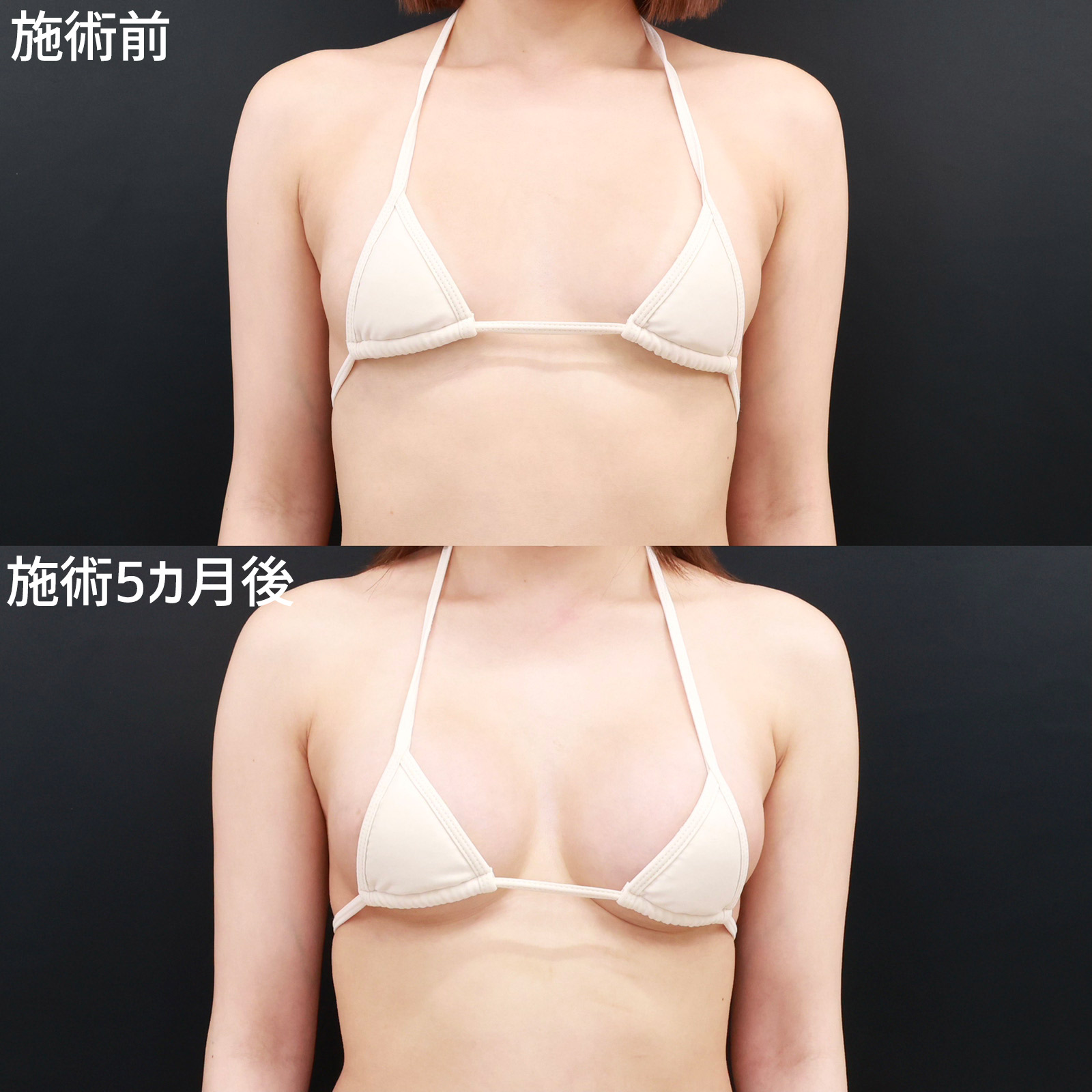 シリコンバッグ豊胸(人工乳腺バッグ)の症例写真 施術前後