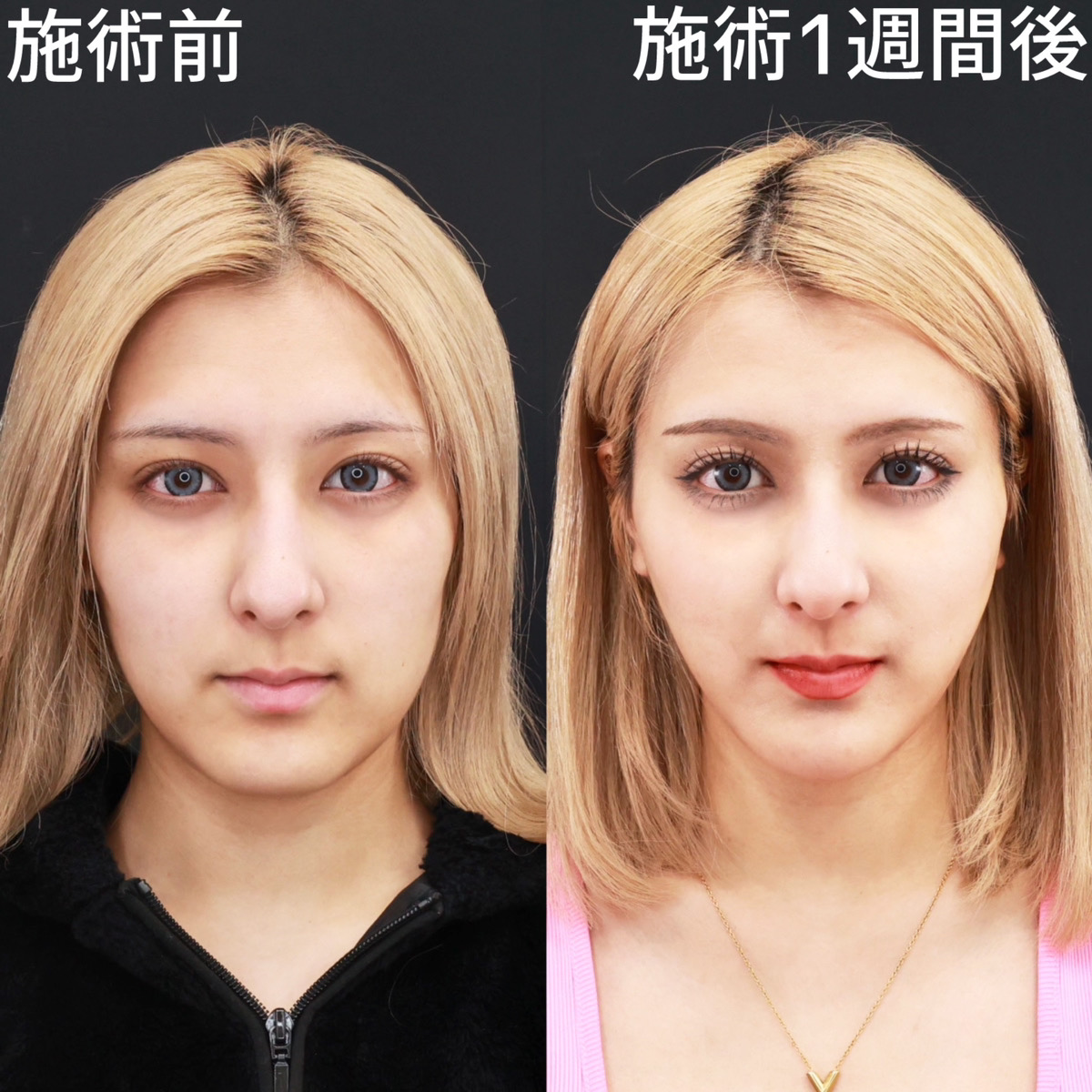 【ジョールファット除去＆糸リフト極】たった1週間でアプリ級の輪郭に！