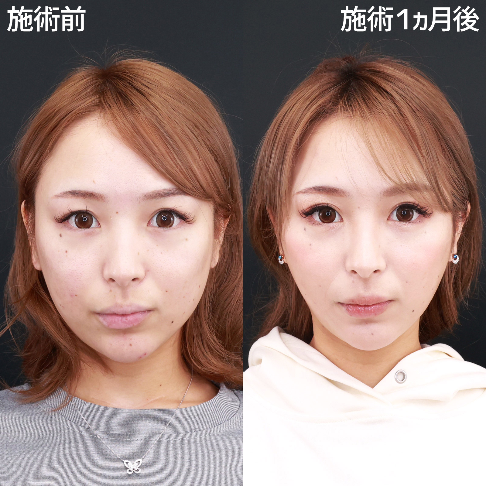 【糸リフト極】顔の余白を減らして、より可愛く！自然に垢抜ける小顔術