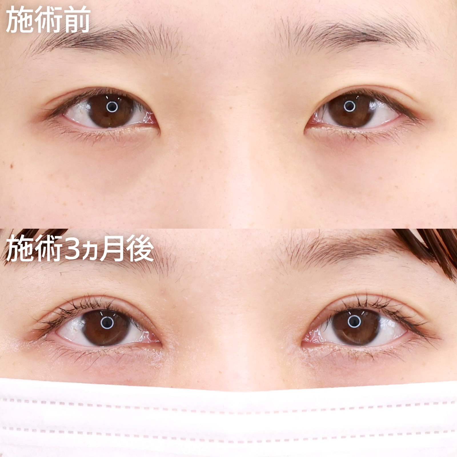 【他院修正】二重ラインと目の開きを調整して、さらにかわいい目元に