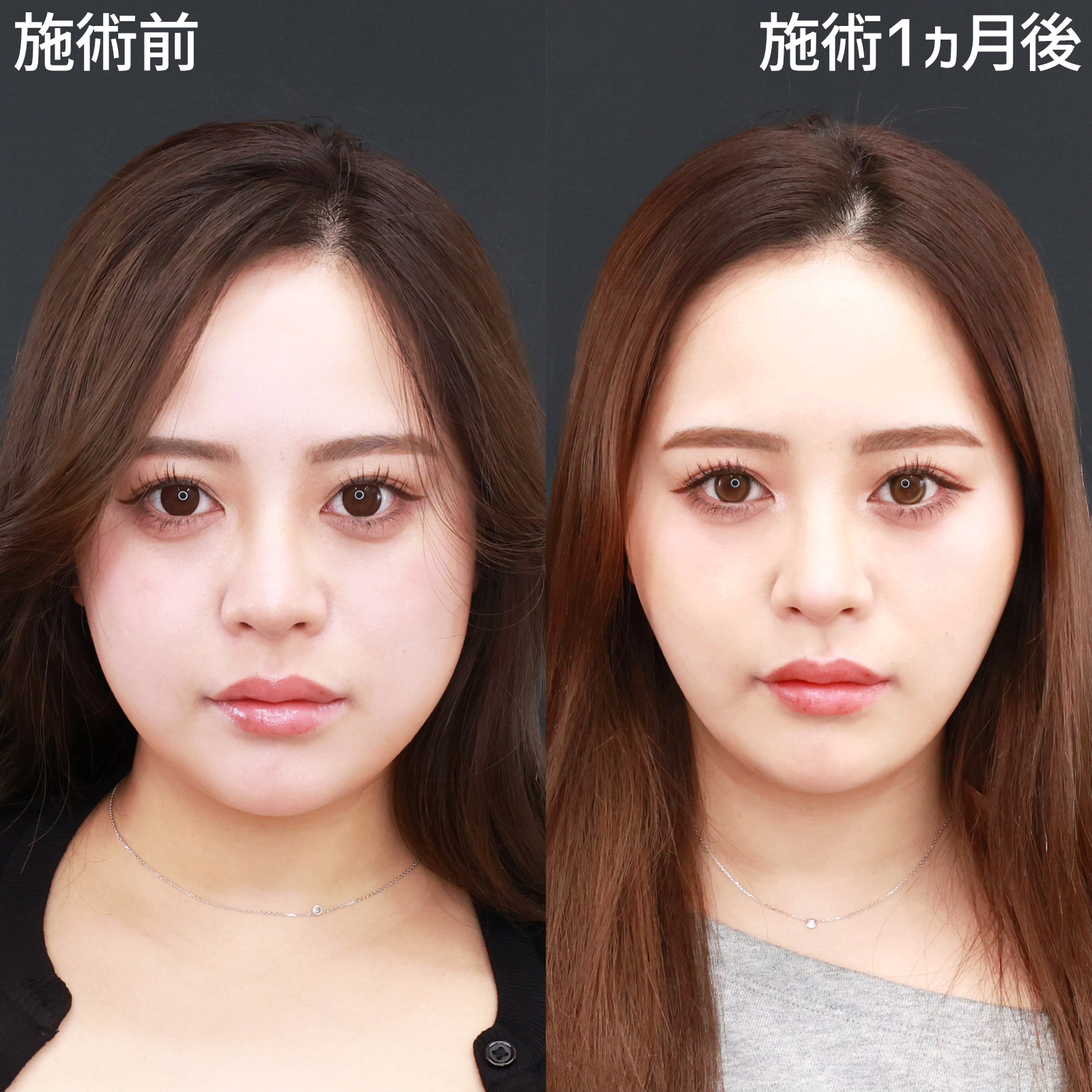 TAC式 ツヤ肌コラーゲンリフト®/ジョールファット除去/エラボトックス注射の症例写真 施術前後