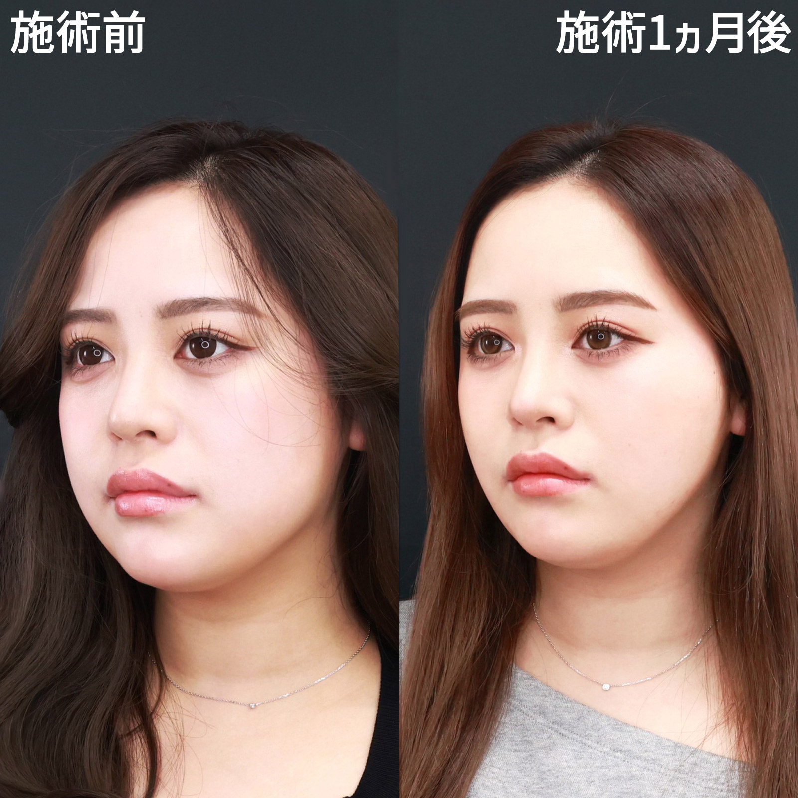 TAC式 ツヤ肌コラーゲンリフト®/ジョールファット除去/エラボトックス注射の症例写真 施術前後