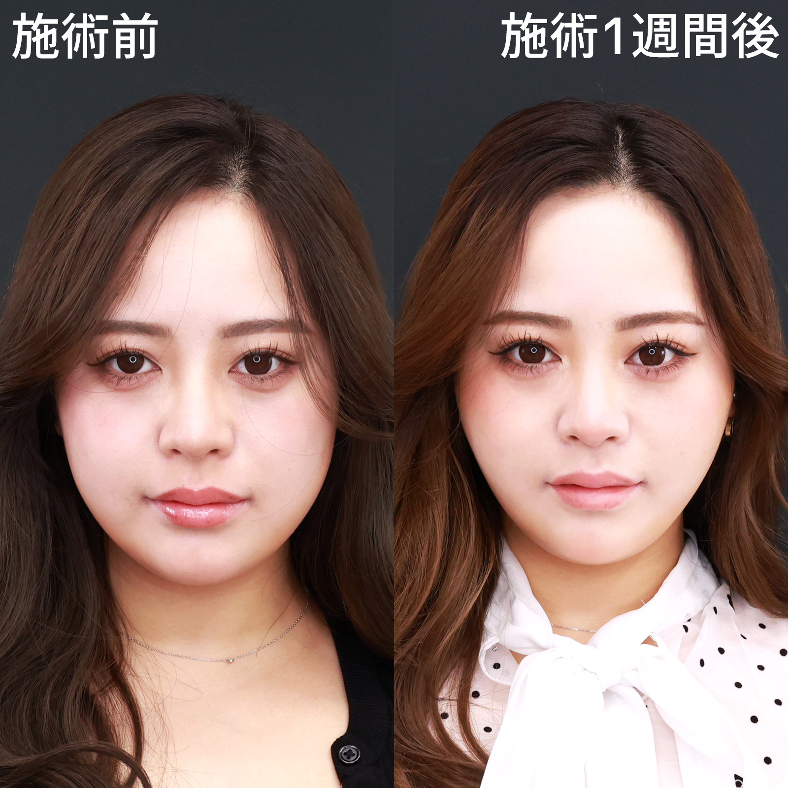 【糸リフト極＆ジョールファット除去】四角い輪郭が、たった1週間でシャープなVラインに！