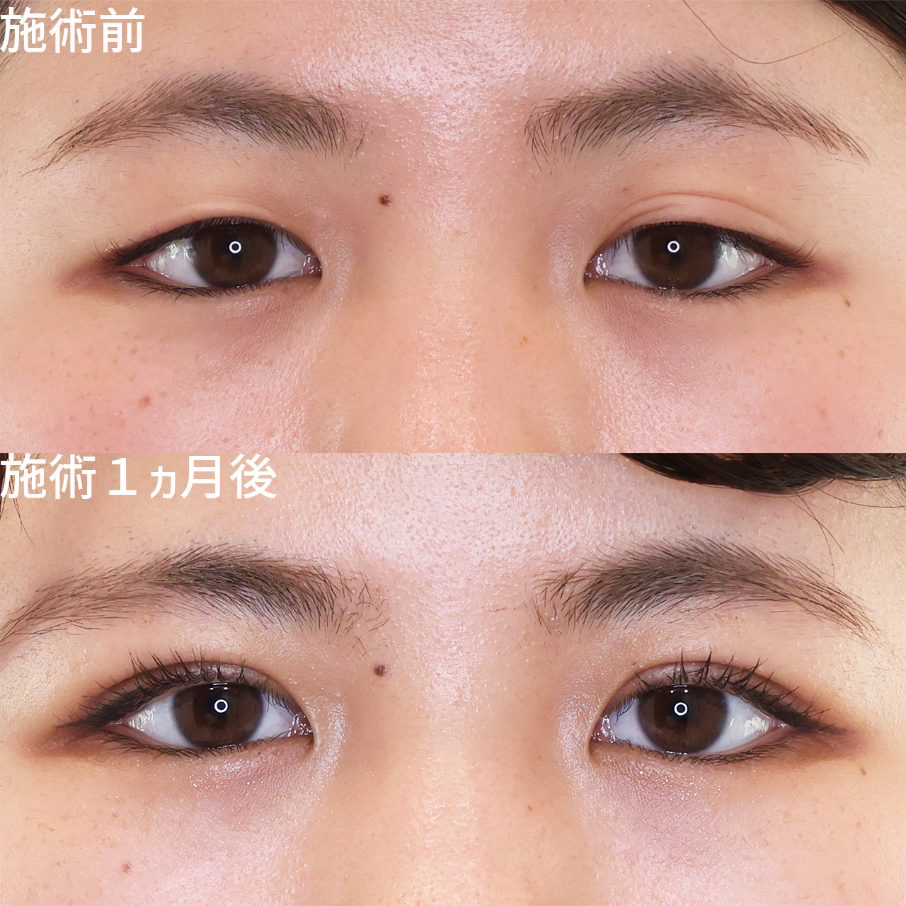 二重埋没法の症例写真 施術前後