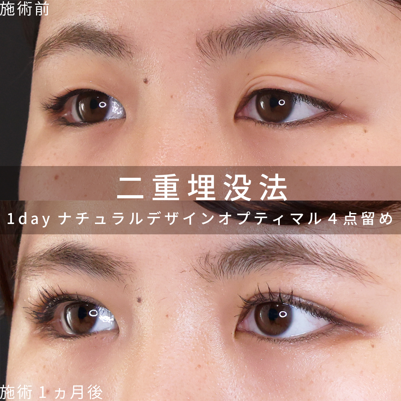 二重埋没法の症例写真 施術前後