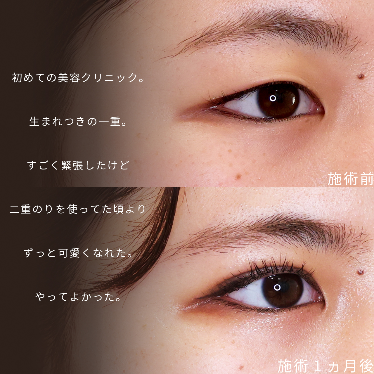 二重埋没法の症例写真 施術前後
