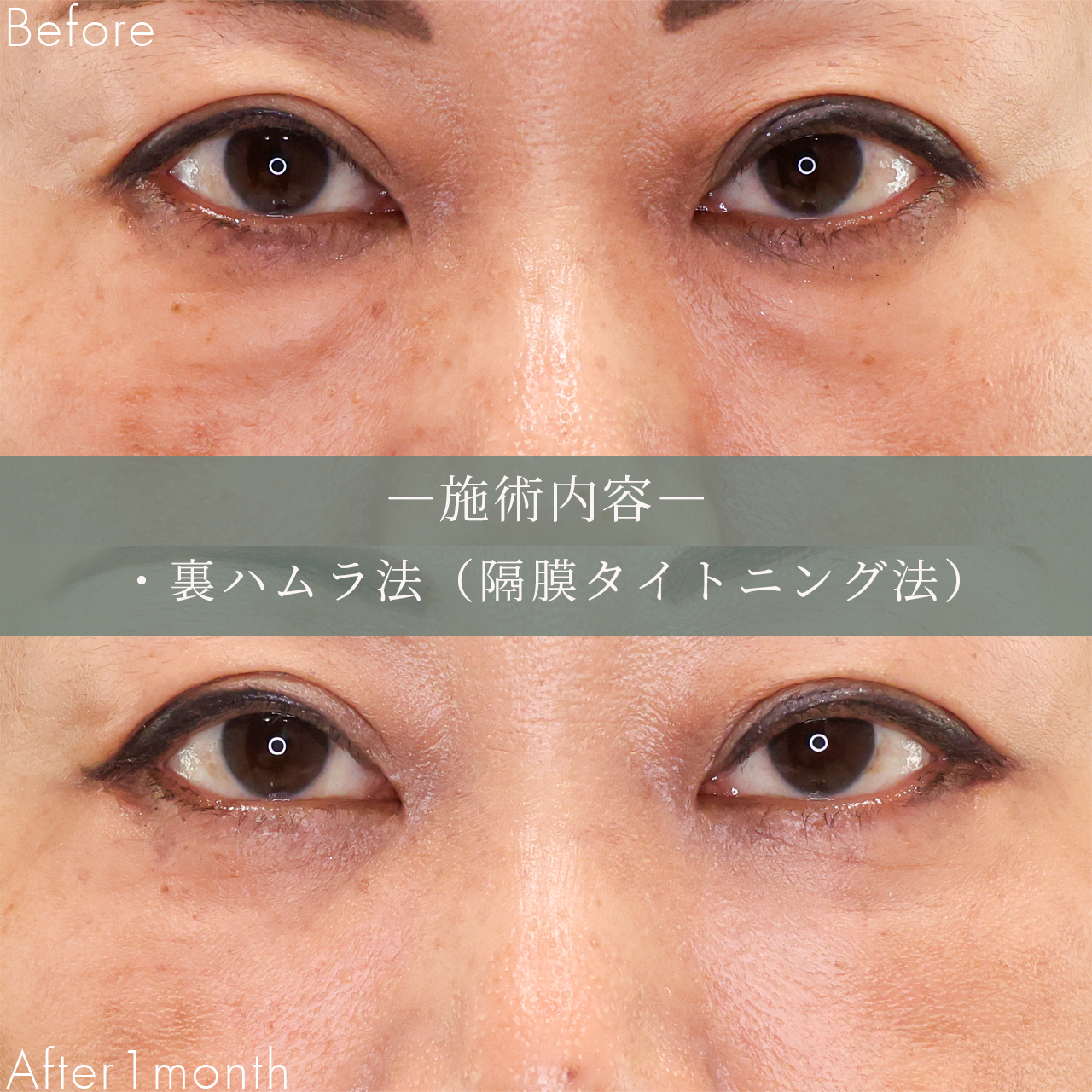 下眼瞼脱脂術（目の下のたるみ取り・目の下の脂肪ふくらみ取り）の症例写真 施術前後 