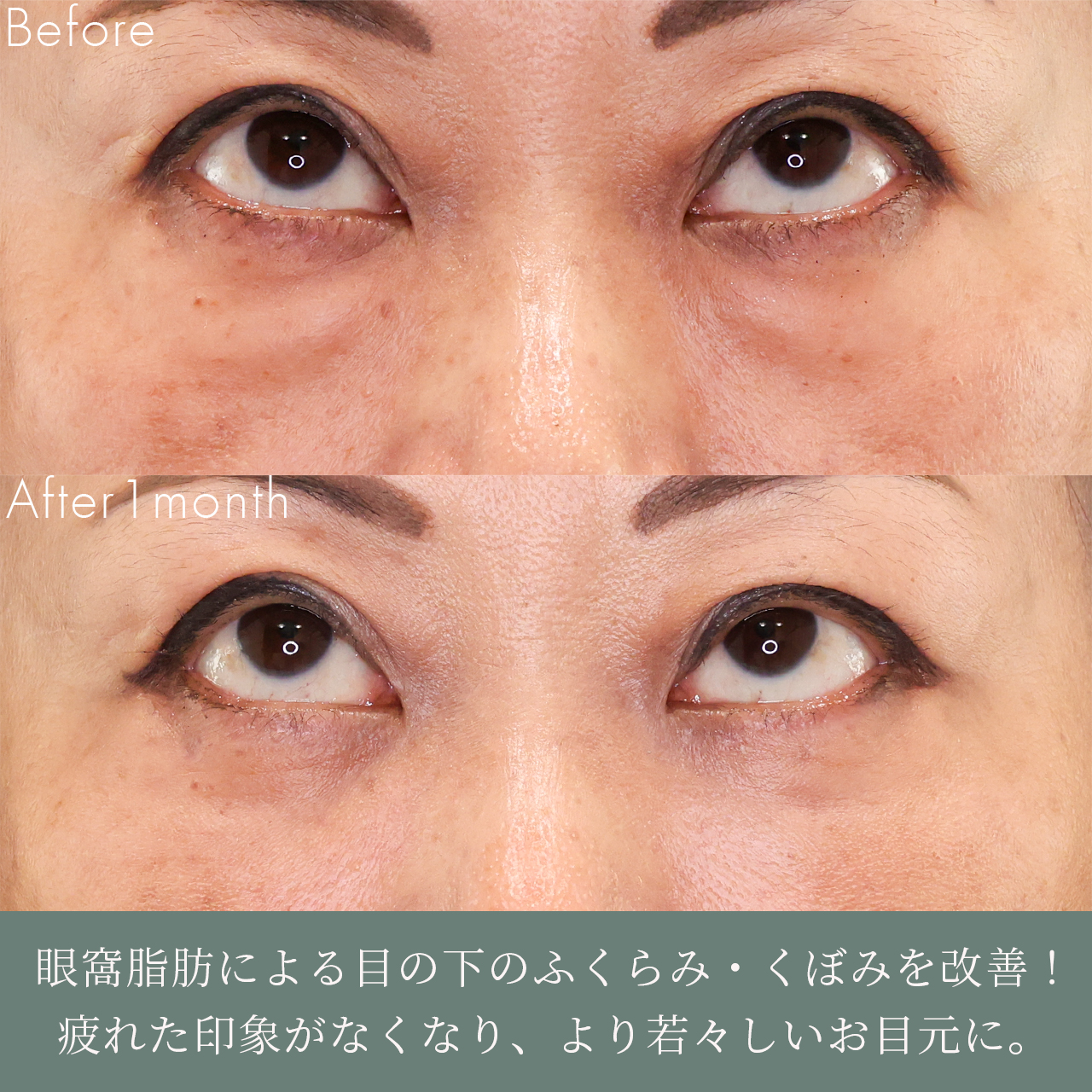 下眼瞼脱脂術（目の下のたるみ取り・目の下の脂肪ふくらみ取り）の症例写真 施術前後 