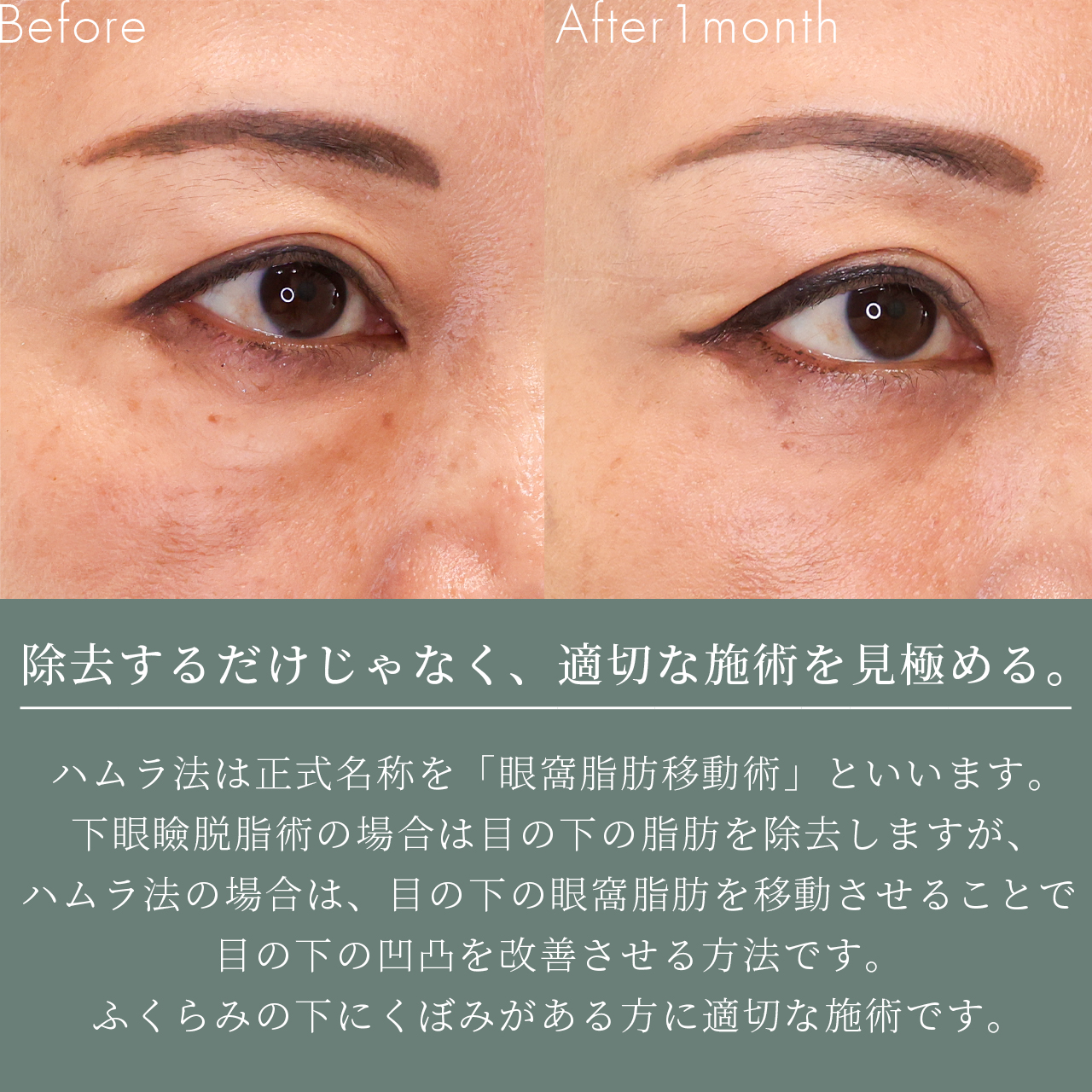 下眼瞼脱脂術（目の下のたるみ取り・目の下の脂肪ふくらみ取り）の症例写真 施術前後 