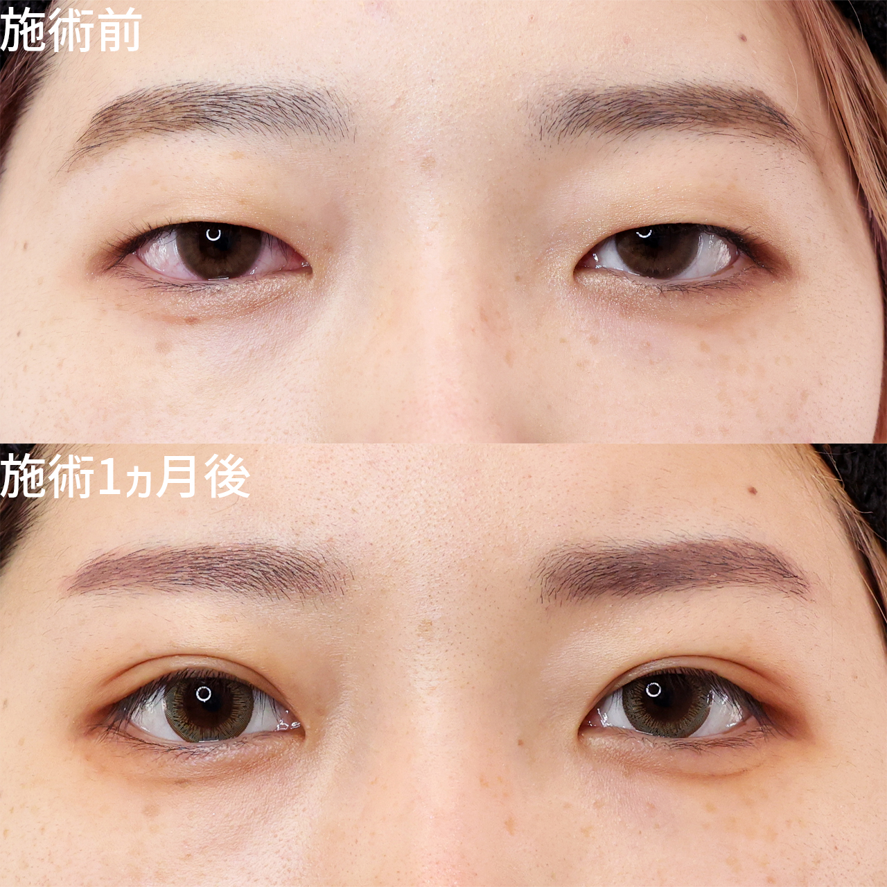 二重メイク卒業宣言。埋没二重で毎朝のメイク時間を短縮！