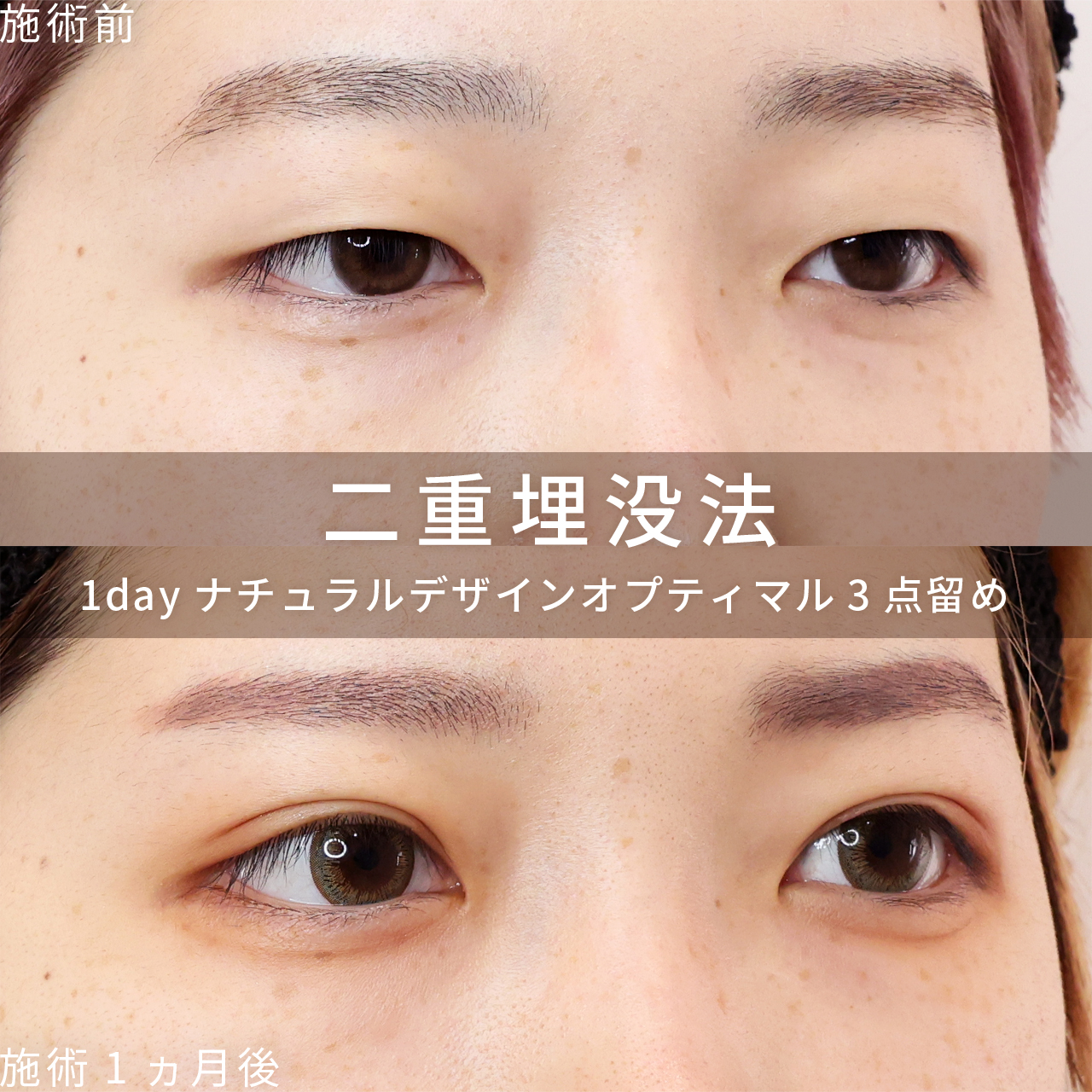 二重埋没法の症例写真 施術前後 