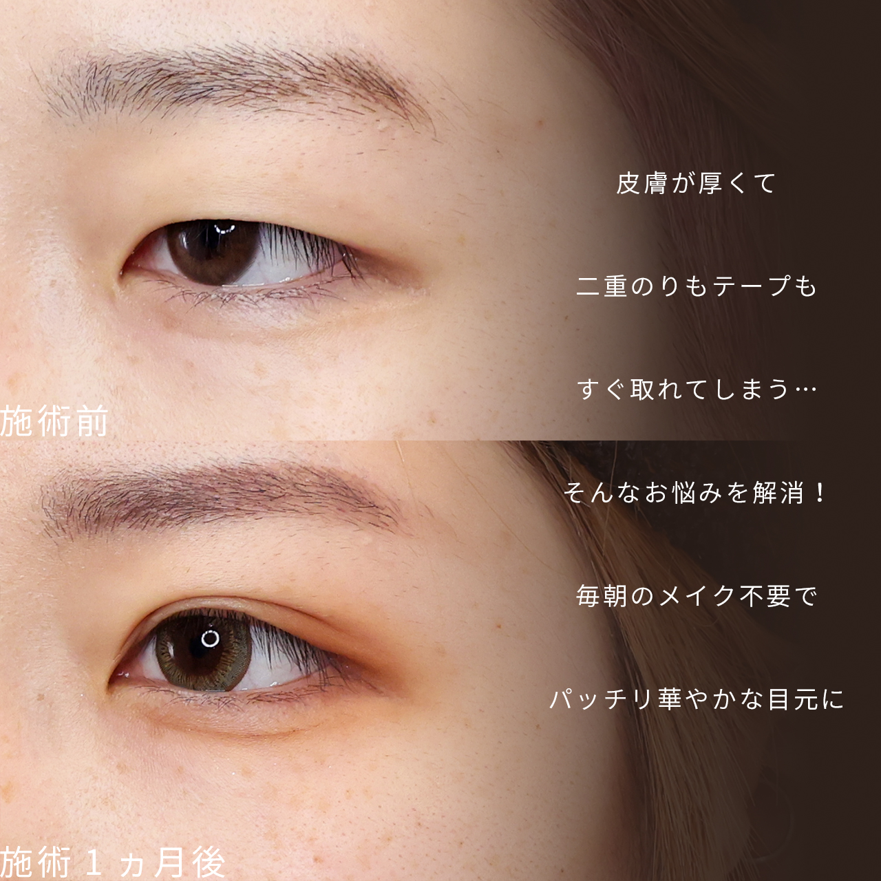 二重埋没法の症例写真 施術前後 