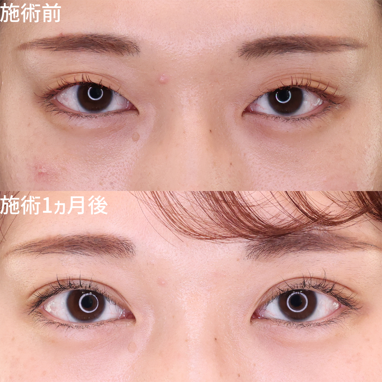 パッとしない目元からモテ目元に【二重埋没法】でパッチリ二重