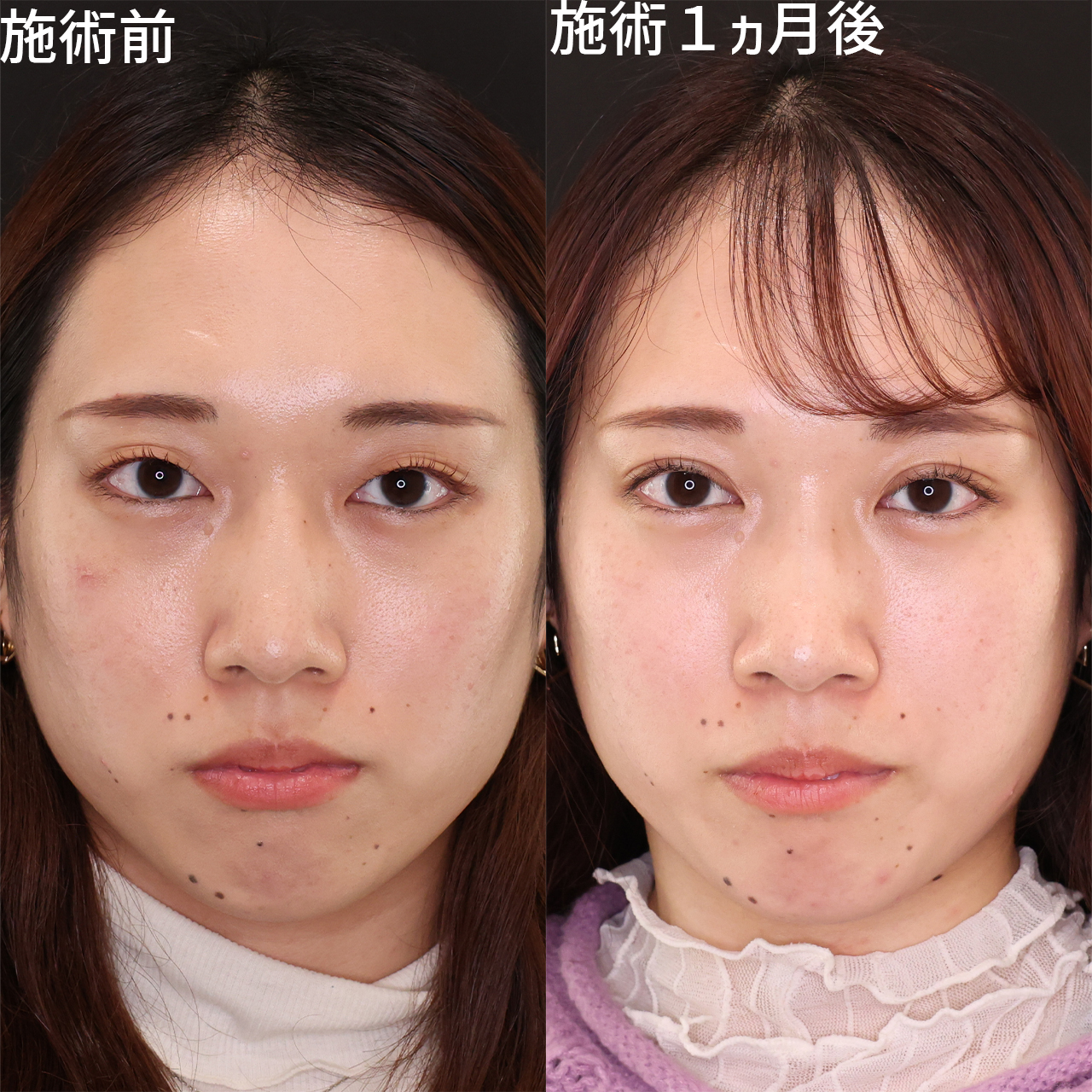 二重埋没法の症例写真 施術前後 