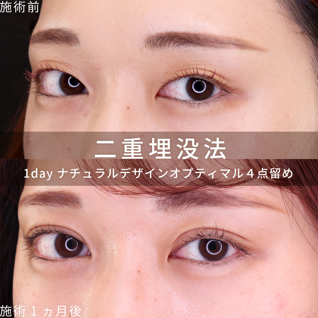 二重埋没法の症例写真 施術前後 