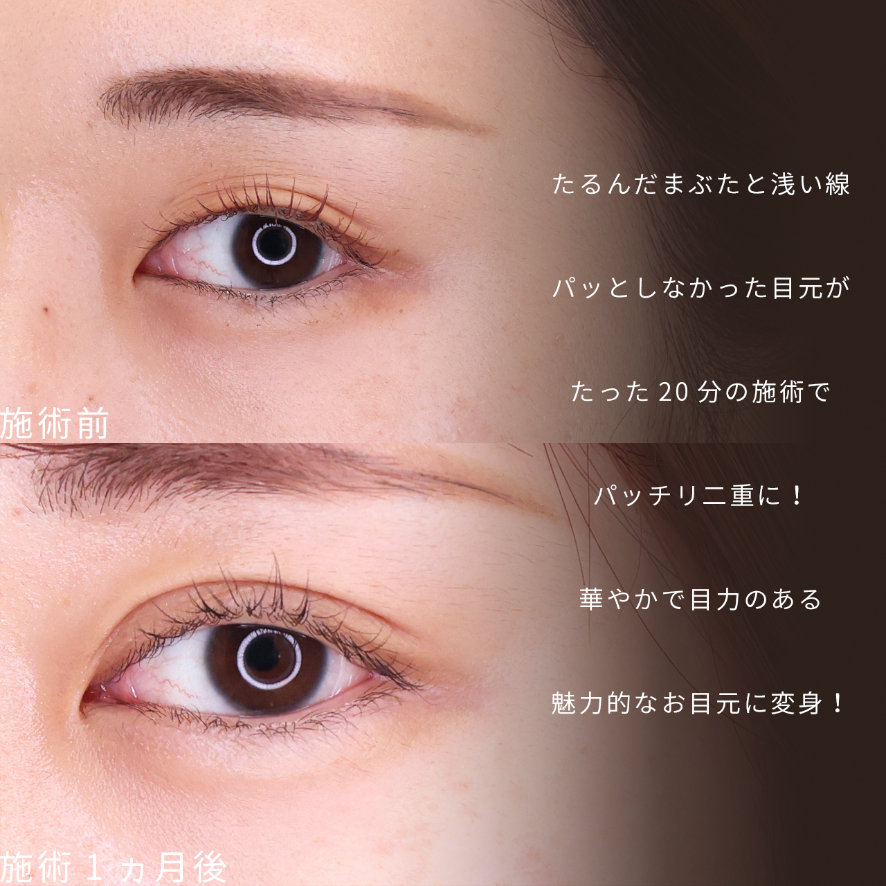 二重埋没法の症例写真 施術前後 