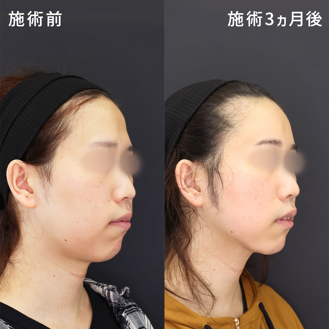 男性の凹みすぎたおでこを改善＆顎下の脂肪吸引でスッキリと！