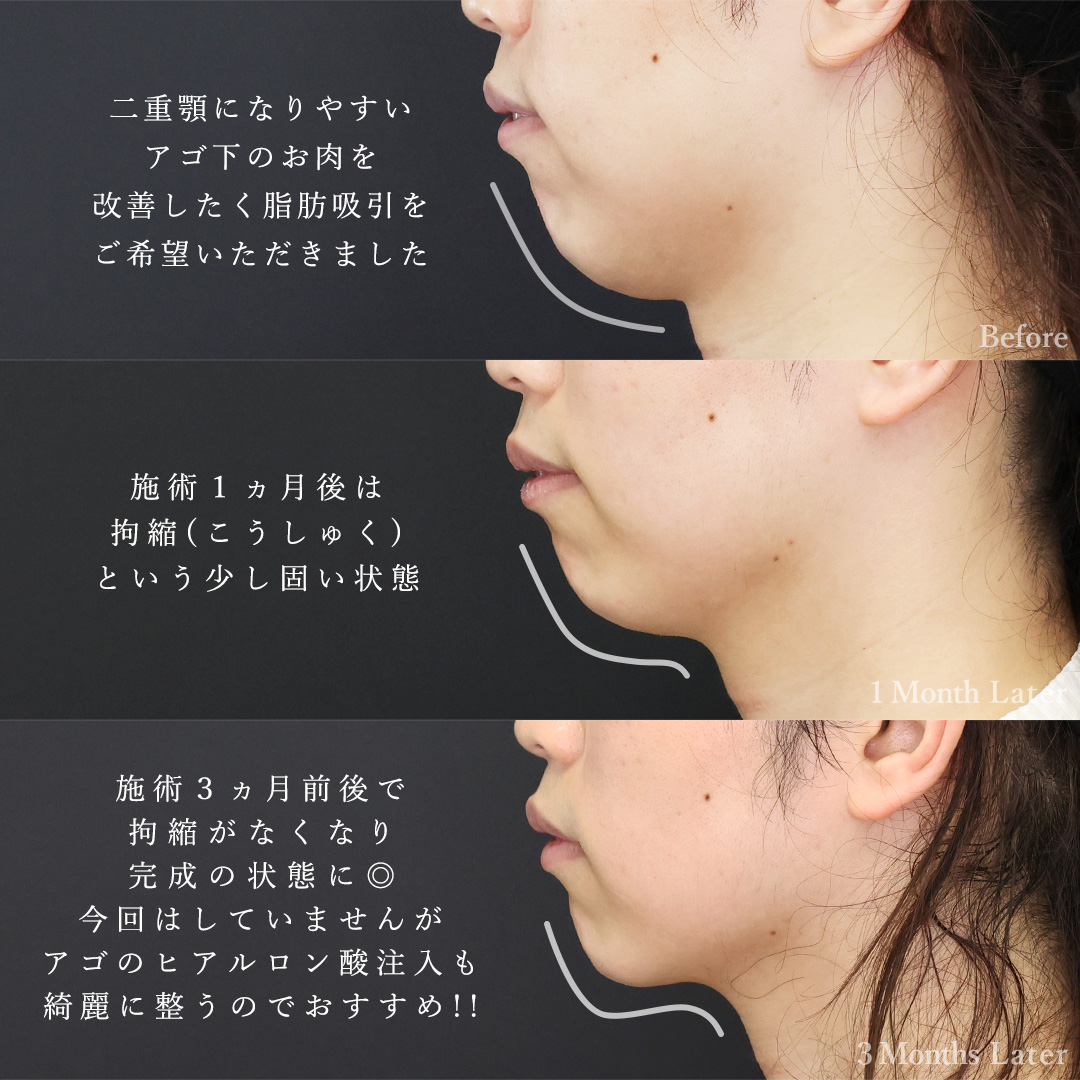 おでこの脂肪注入（オルチャンデコ形成）/顔の脂肪注入(コンデンスリッチフェイス)/顎下の脂肪吸引の症例写真 施術前後 