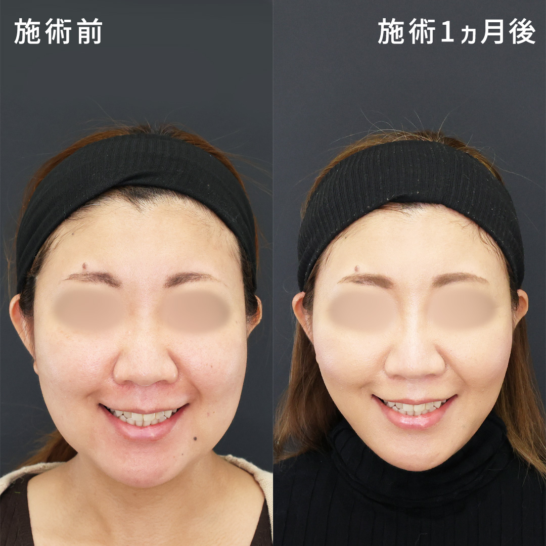 【ナチュラルな顔痩せで】自信のもてる笑顔へ｜ミドル世代