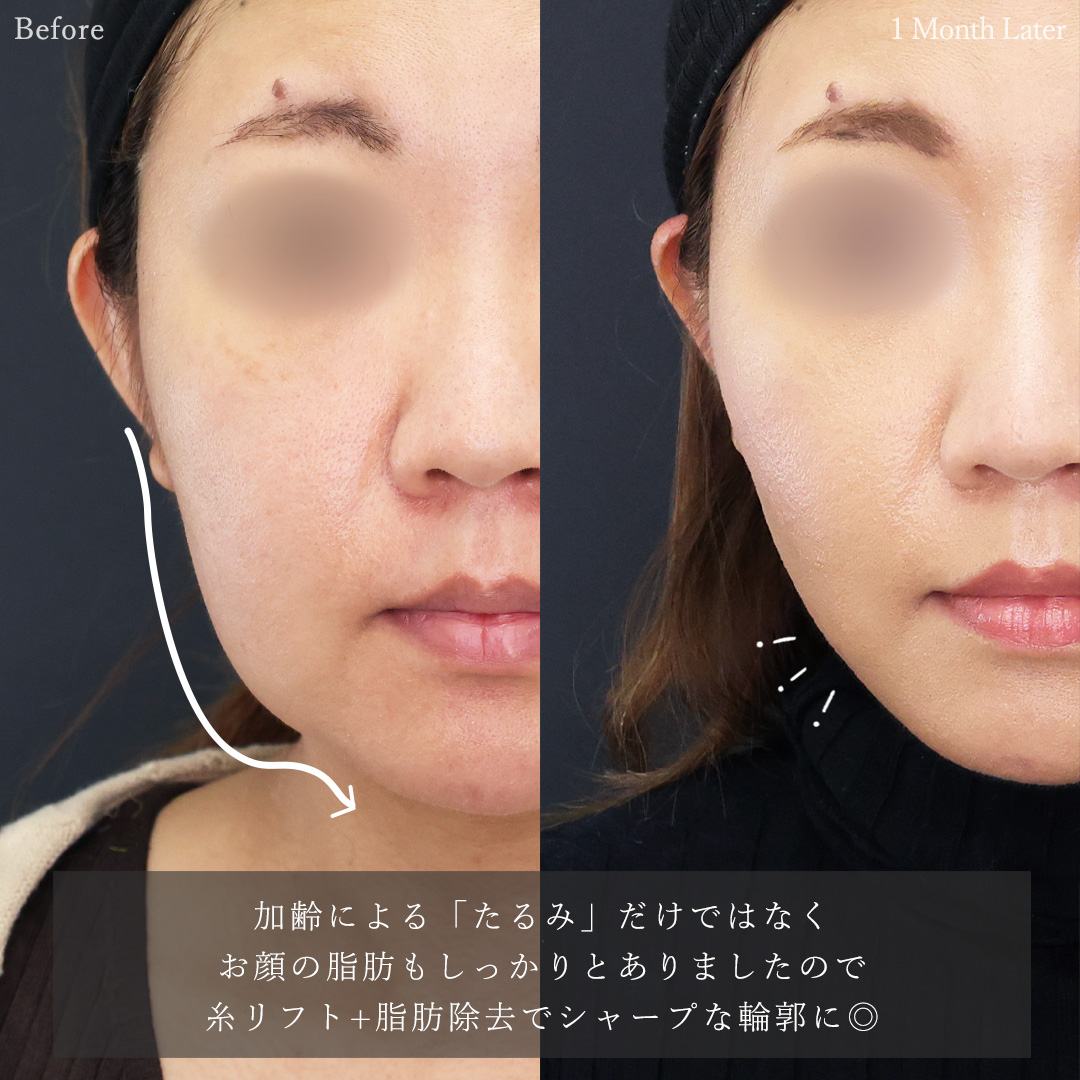 TAC式 ツヤ肌コラーゲンリフト®/ジョールファット除去/バッカルファット除去の症例写真 施術前後 