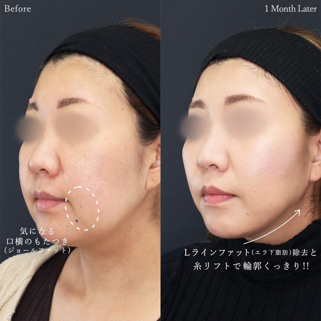TAC式 ツヤ肌コラーゲンリフト®/ジョールファット除去/バッカルファット除去の症例写真 施術前後 