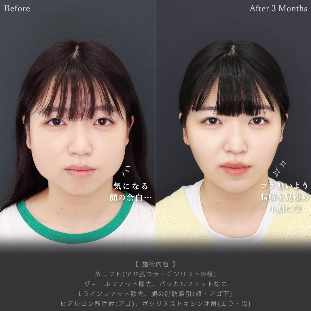 TAC式 ツヤ肌コラーゲンリフト®/ジョールファット除去/バッカルファット除去の症例写真 施術前後