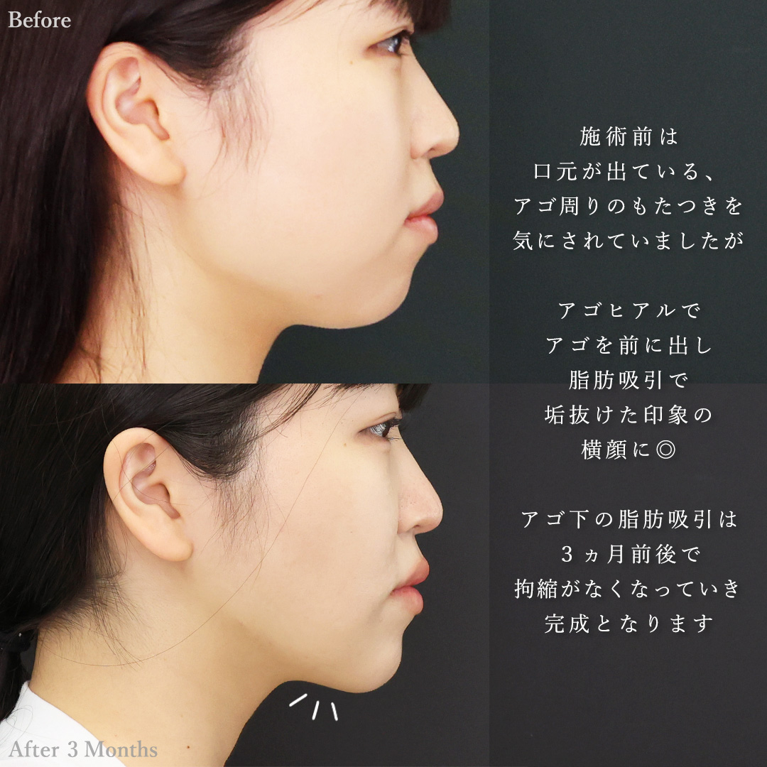TAC式 ツヤ肌コラーゲンリフト®/ジョールファット除去/バッカルファット除去の症例写真 施術前後