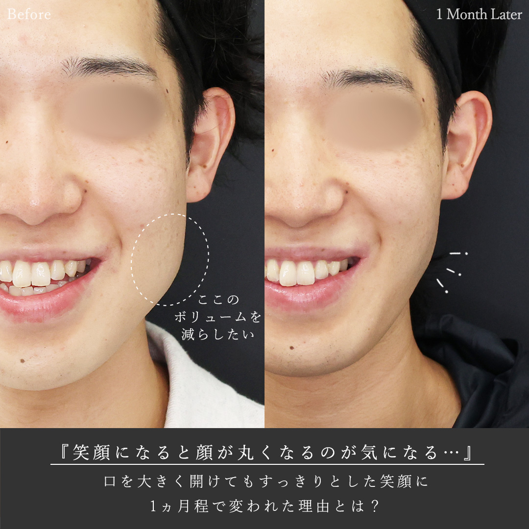 バッカルファット除去/エラボトックス注射の症例写真 施術前後 